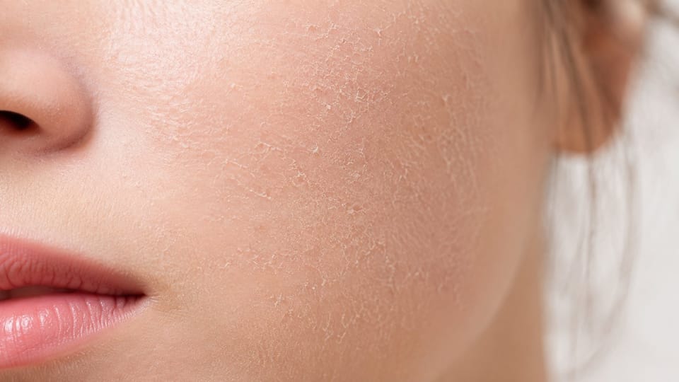 Da khô mất nước sau khi đi máy bay đường dài
