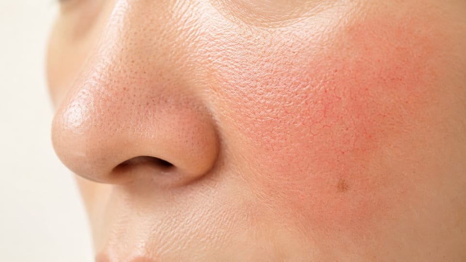 Dùng máy hút nhân mụn sai cách gây giãn mao mạch và tổn thương da mãn tính