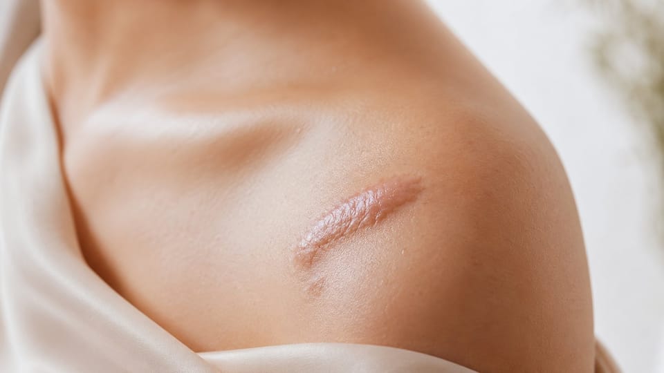 Keloid (Sẹo Lồi) Là Gì? Nguyên Nhân, Triệu Chứng và Điều Trị Hiệu Quả